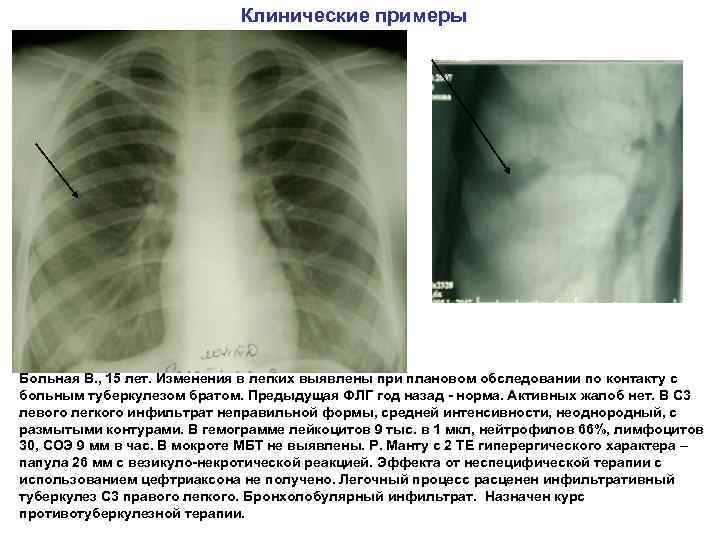 Клинические примеры Больная В. , 15 лет. Изменения в легких выявлены при плановом обследовании
