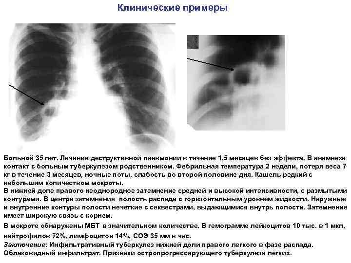 Клинические примеры Больной 35 лет. Лечение деструктивной пневмонии в течение 1, 5 месяцев без