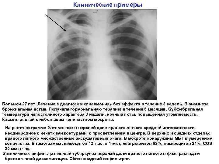 Клинические примеры Больной 27 лет. Лечение с диагнозом «пневмония» без эффекта в течение 3