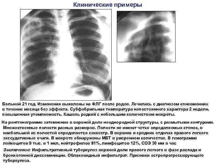 Клинические примеры Больной 21 год. Изменения выявлены на ФЛГ после родов. Лечилась с диагнозом