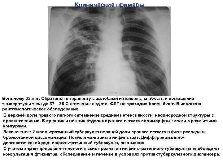 Клинические примеры Больному 35 лет. Обратился к терапевту с жалобами на кашель, слабость и