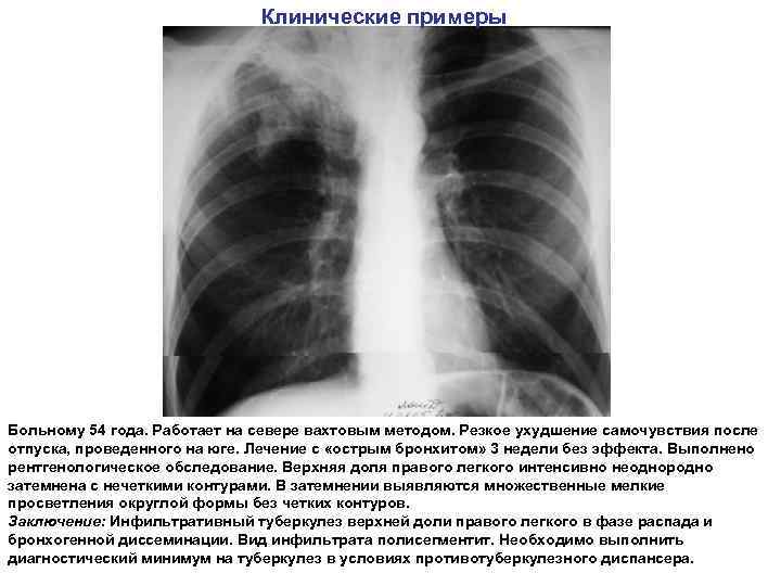 Клинические примеры Больному 54 года. Работает на севере вахтовым методом. Резкое ухудшение самочувствия после