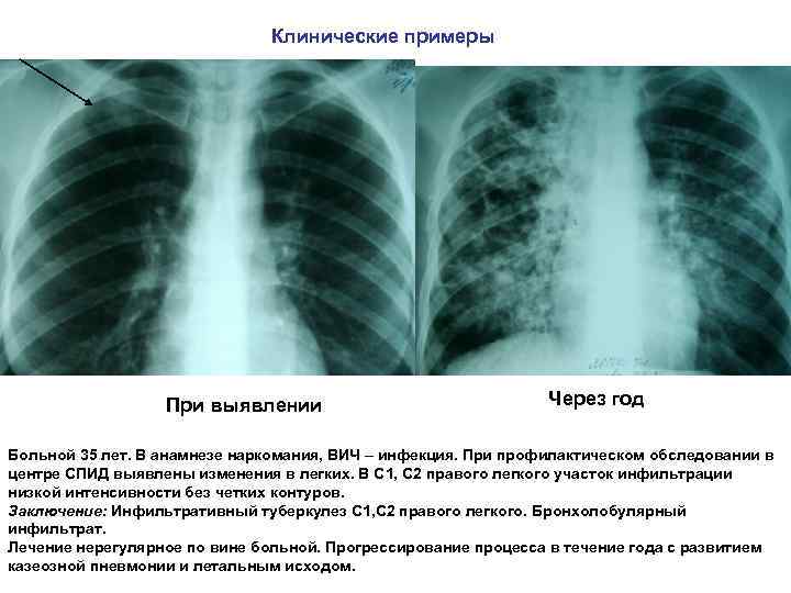 Клинические примеры При выявлении Через год Больной 35 лет. В анамнезе наркомания, ВИЧ –
