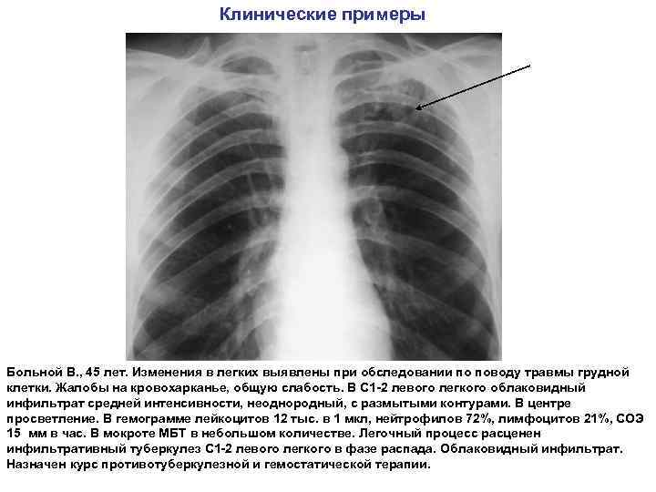 Клинические примеры Больной В. , 45 лет. Изменения в легких выявлены при обследовании по