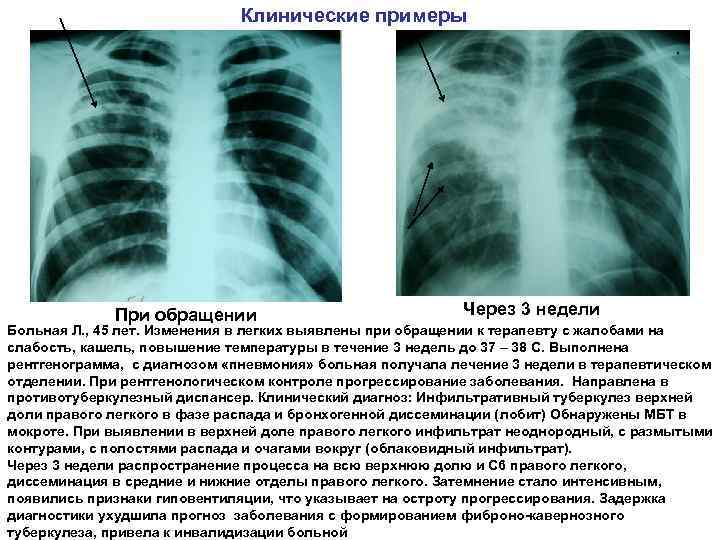 Клинические примеры При обращении Через 3 недели Больная Л. , 45 лет. Изменения в
