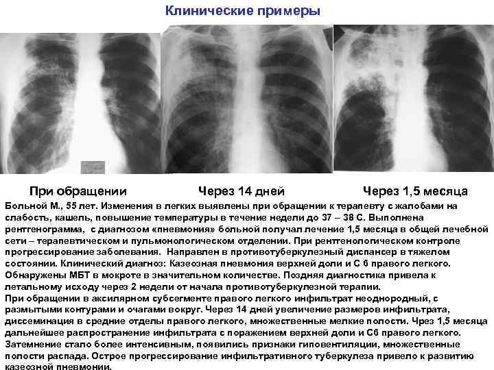 Клинические примеры При обращении Через 14 дней Через 1, 5 месяца Больной М. ,