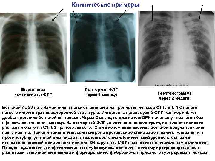 Клинические примеры Выявление патологии на ФЛГ Повторная ФЛГ через 3 месяца Рентгенограмма через 2