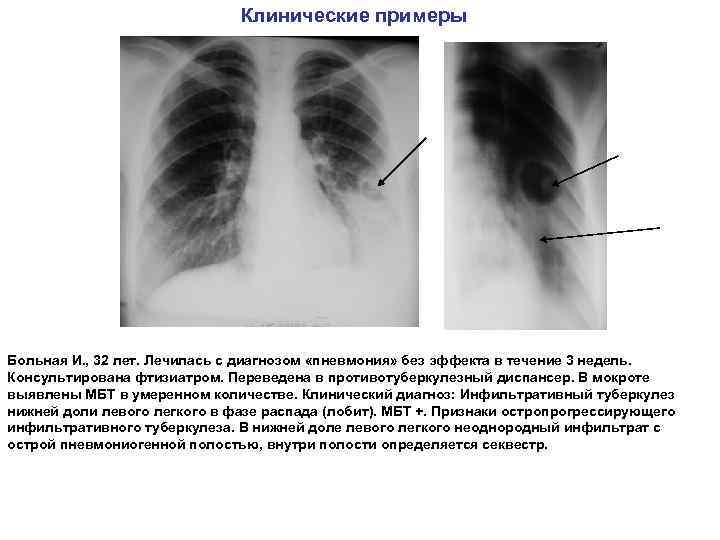 Клинические примеры Больная И. , 32 лет. Лечилась с диагнозом «пневмония» без эффекта в