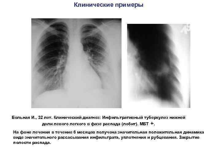 Клинические примеры Больная И. , 32 лет. Клинический диагноз: Инфильтративный туберкулез нижней доли левого