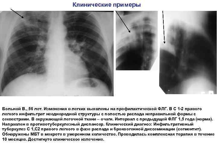 Клинические примеры Больной В. , 56 лет. Изменения в легких выявлены на профилактической ФЛГ.