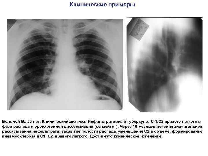Клинические примеры Больной В. , 56 лет. Клинический диагноз: Инфильтративный туберкулез С 1, С