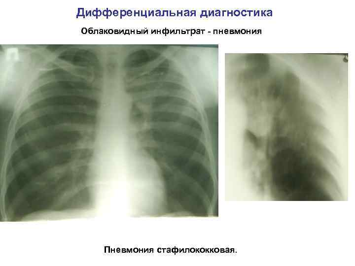 Дифференциальная диагностика Облаковидный инфильтрат - пневмония Пневмония стафилококковая. 