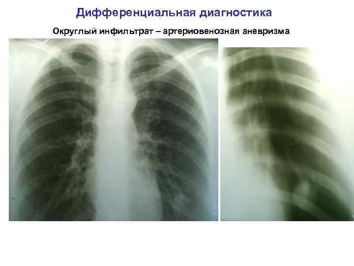 Дифференциальная диагностика Округлый инфильтрат – артериовенозная аневризма 