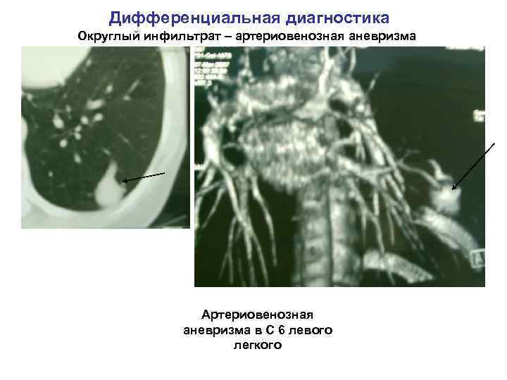 Дифференциальная диагностика Округлый инфильтрат – артериовенозная аневризма Артериовенозная аневризма в С 6 левого легкого