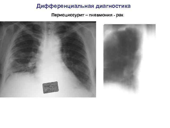 Дифференциальная диагностика Перисциссурит – пневмония - рак 