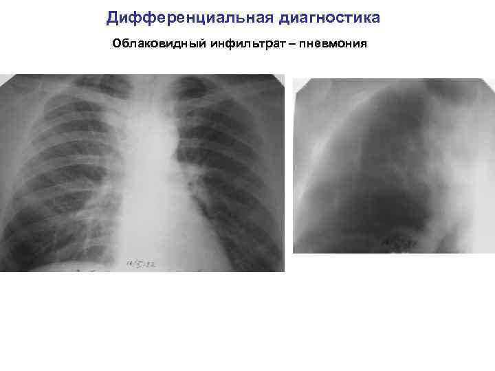 Дифференциальная диагностика Облаковидный инфильтрат – пневмония 