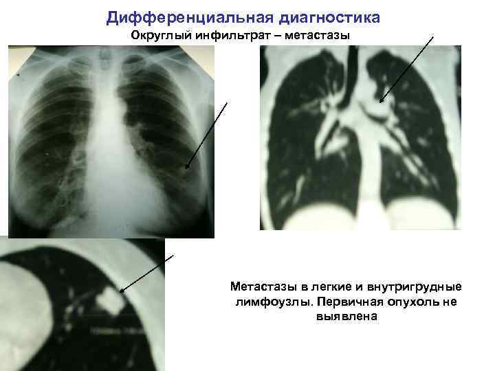 Дифференциальная диагностика Округлый инфильтрат – метастазы Метастазы в легкие и внутригрудные лимфоузлы. Первичная опухоль