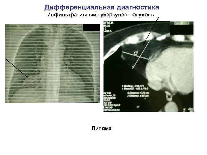 Дифференциальная диагностика Инфильтративный туберкулез – опухоль Липома 