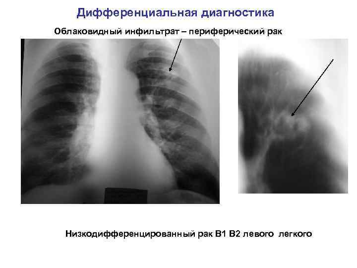 Дифференциальная диагностика Облаковидный инфильтрат – периферический рак Низкодифференцированный рак В 1 В 2 левого