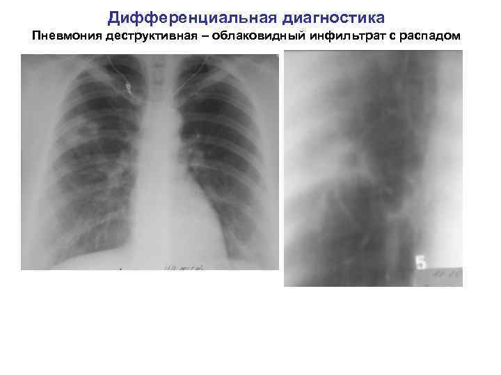 Дифференциальная диагностика Пневмония деструктивная – облаковидный инфильтрат с распадом 
