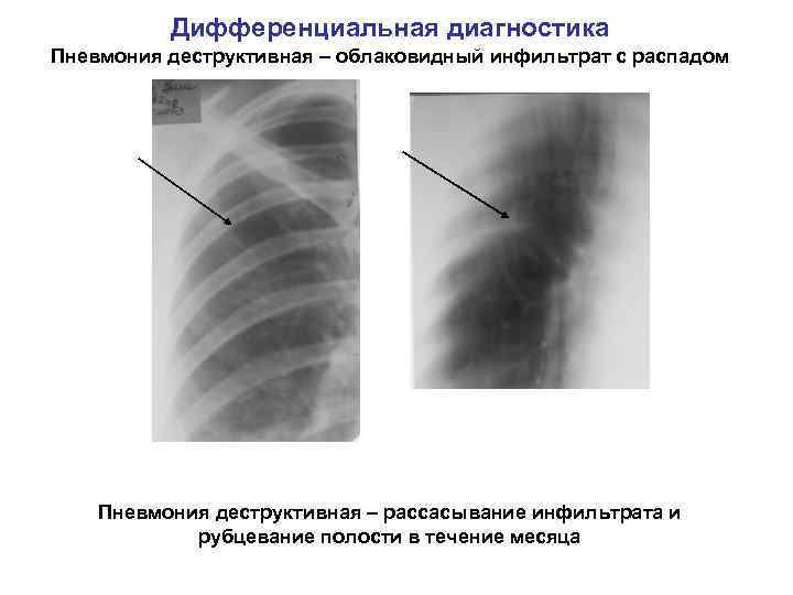 Дифференциальная диагностика Пневмония деструктивная – облаковидный инфильтрат с распадом Пневмония деструктивная – рассасывание инфильтрата