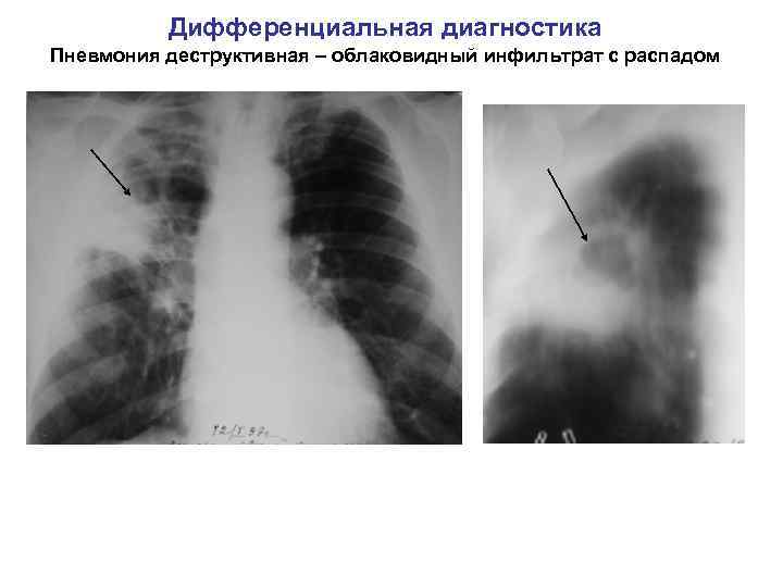 Дифференциальная диагностика Пневмония деструктивная – облаковидный инфильтрат с распадом 