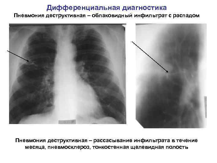 Дифференциальная диагностика Пневмония деструктивная – облаковидный инфильтрат с распадом Пневмония деструктивная – рассасывание инфильтрата