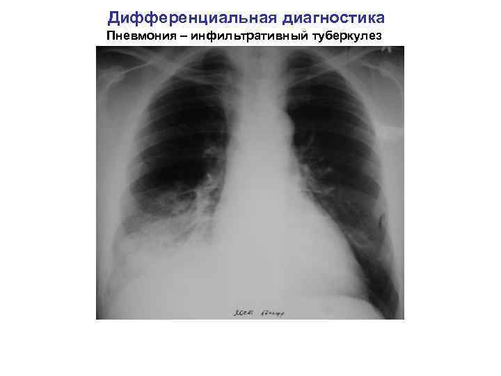 Дифференциальная диагностика Пневмония – инфильтративный туберкулез 