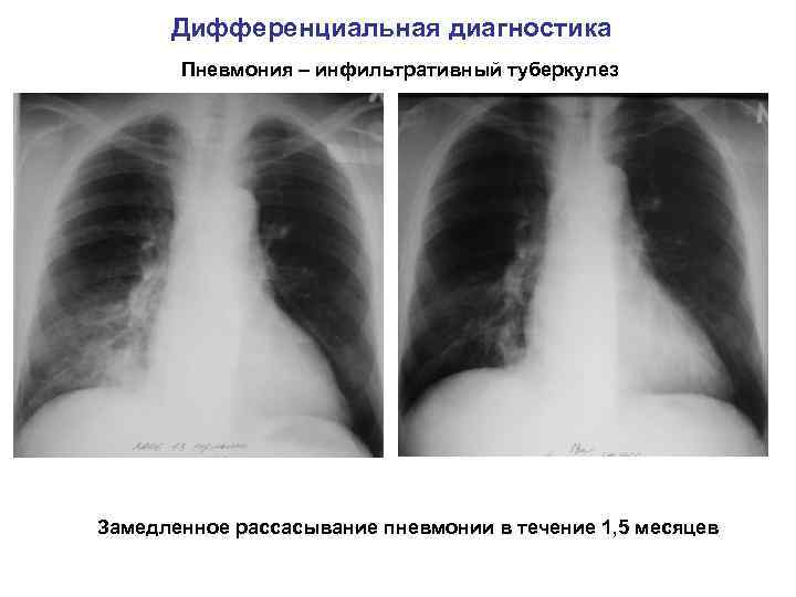 Дифференциальная диагностика Пневмония – инфильтративный туберкулез Замедленное рассасывание пневмонии в течение 1, 5 месяцев