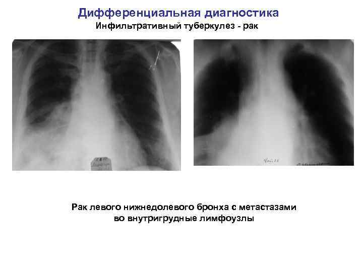 Дифференциальная диагностика Инфильтративный туберкулез - рак Рак левого нижнедолевого бронха с метастазами во внутригрудные