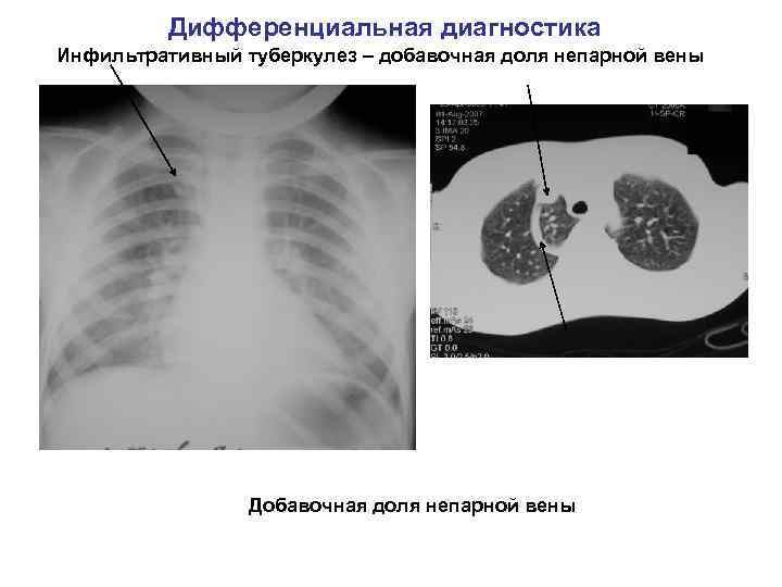 Дифференциальная диагностика Инфильтративный туберкулез – добавочная доля непарной вены Добавочная доля непарной вены 