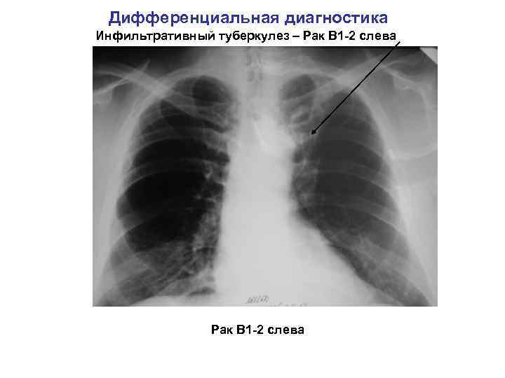 Дифференциальная диагностика Инфильтративный туберкулез – Рак В 1 -2 слева 