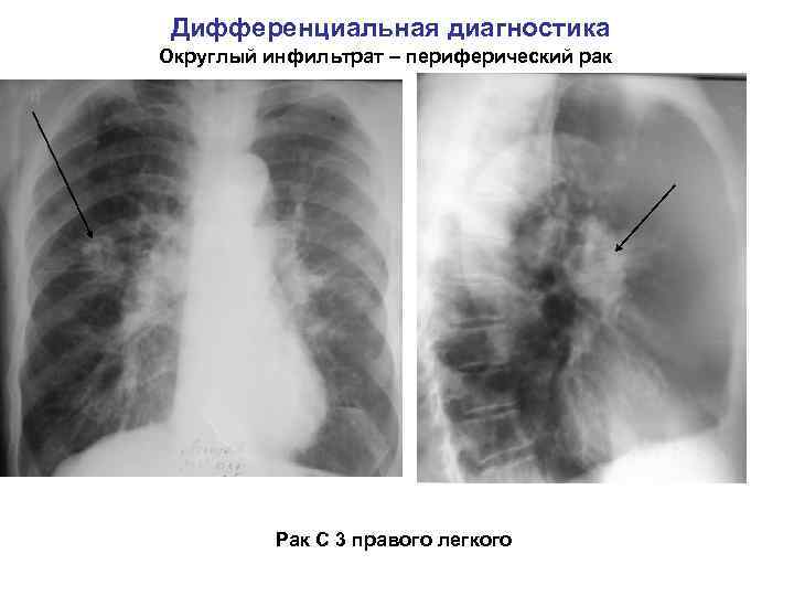 Дифференциальная диагностика Округлый инфильтрат – периферический рак Рак С 3 правого легкого 