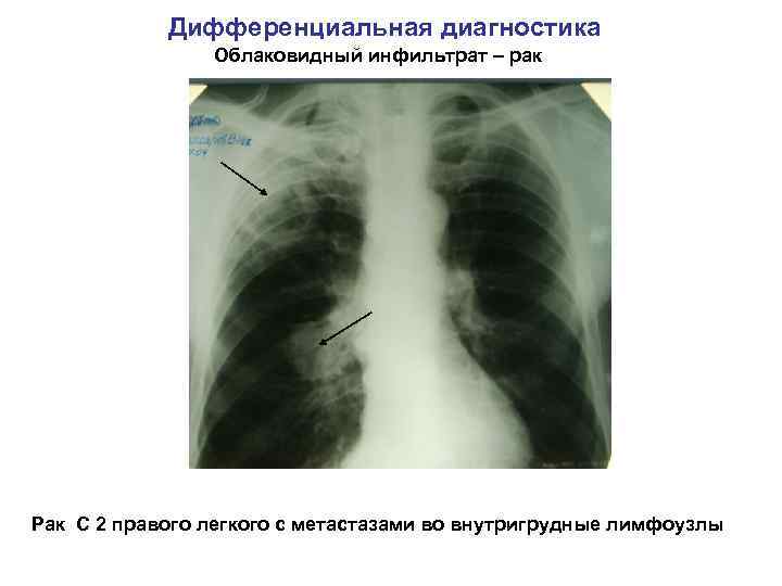 Дифференциальная диагностика Облаковидный инфильтрат – рак Рак С 2 правого легкого с метастазами во