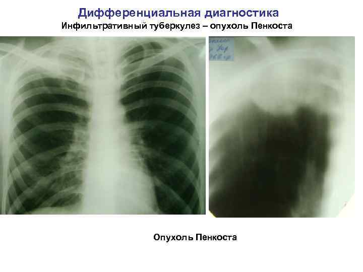 Дифференциальная диагностика Инфильтративный туберкулез – опухоль Пенкоста Опухоль Пенкоста 
