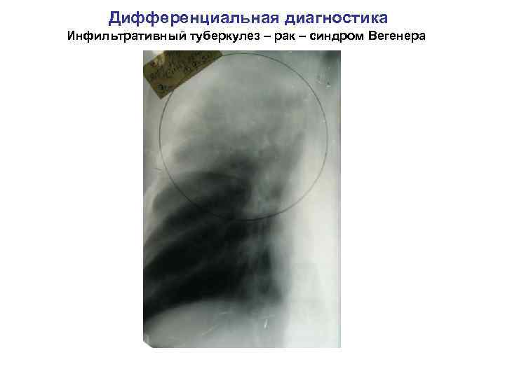 Дифференциальная диагностика Инфильтративный туберкулез – рак – синдром Вегенера 