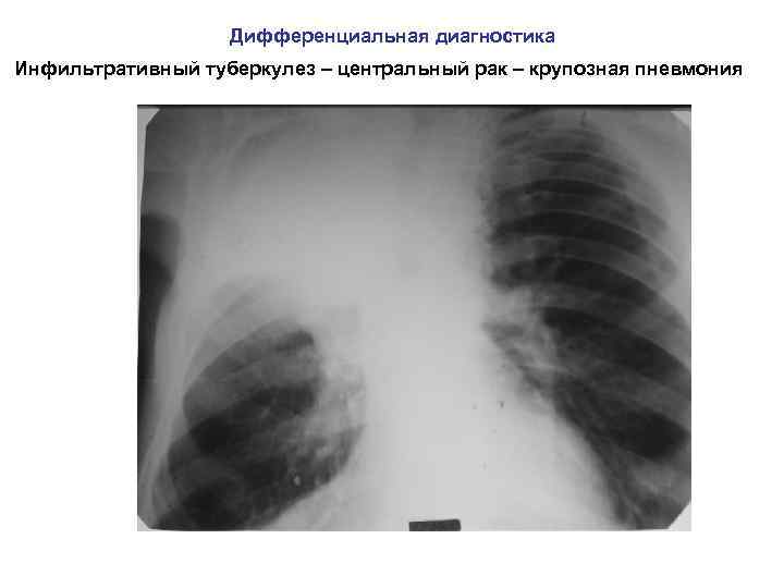 Дифференциальная диагностика Инфильтративный туберкулез – центральный рак – крупозная пневмония 