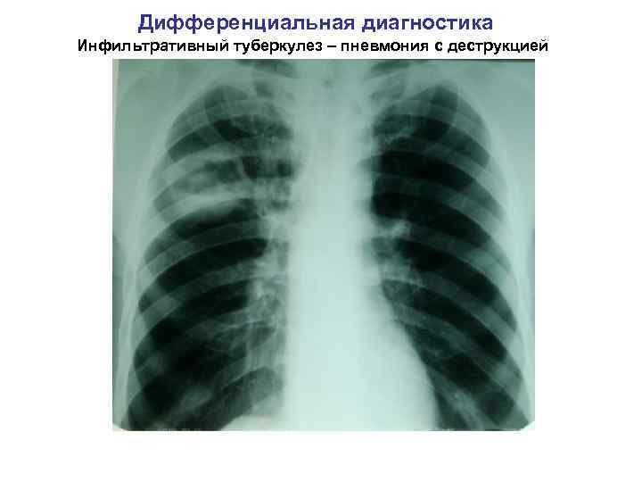Дифференциальная диагностика Инфильтративный туберкулез – пневмония с деструкцией 