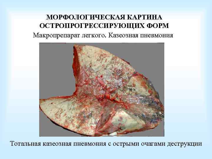 МОРФОЛОГИЧЕСКАЯ КАРТИНА ОСТРОПРОГРЕССИРУЮЩИХ ФОРМ Макропрепарат легкого. Казеозная пневмония Тотальная казеозная пневмония с острыми очагами