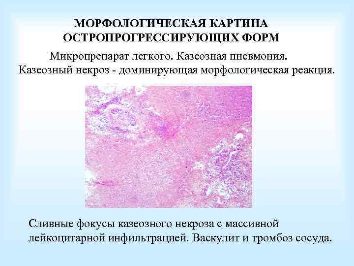 МОРФОЛОГИЧЕСКАЯ КАРТИНА ОСТРОПРОГРЕССИРУЮЩИХ ФОРМ Микропрепарат легкого. Казеозная пневмония. Казеозный некроз - доминирующая морфологическая реакция.