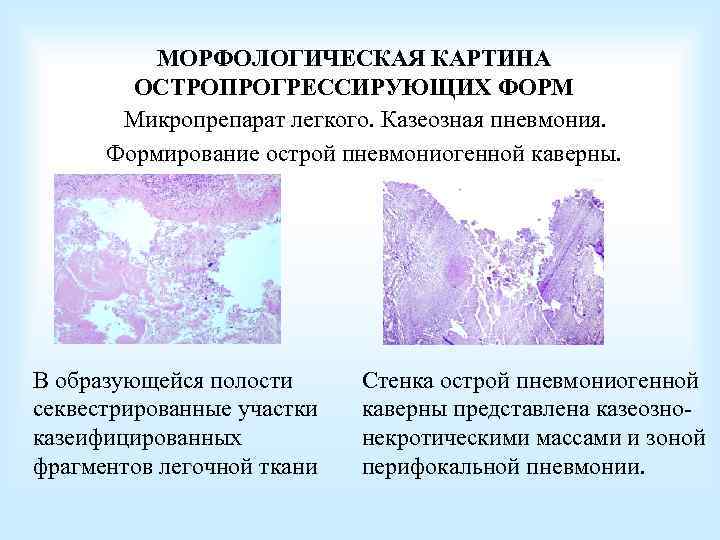 МОРФОЛОГИЧЕСКАЯ КАРТИНА ОСТРОПРОГРЕССИРУЮЩИХ ФОРМ Микропрепарат легкого. Казеозная пневмония. Формирование острой пневмониогенной каверны. В образующейся