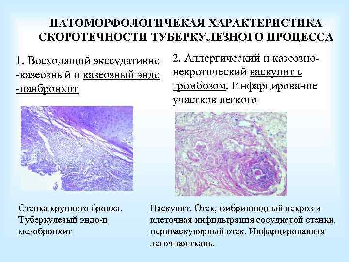 ПАТОМОРФОЛОГИЧЕКАЯ ХАРАКТЕРИСТИКА СКОРОТЕЧНОСТИ ТУБЕРКУЛЕЗНОГО ПРОЦЕССА 1. Восходящий экссудативно -казеозный и казеозный эндо -панбронхит Стенка