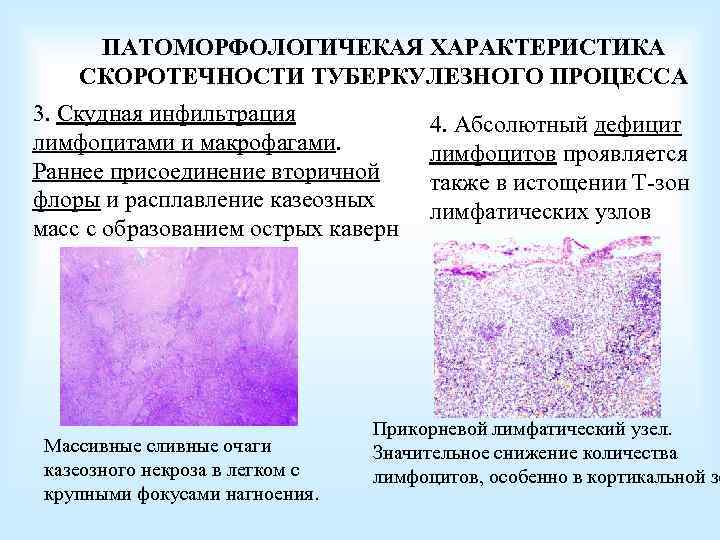 ПАТОМОРФОЛОГИЧЕКАЯ ХАРАКТЕРИСТИКА СКОРОТЕЧНОСТИ ТУБЕРКУЛЕЗНОГО ПРОЦЕССА 3. Скудная инфильтрация лимфоцитами и макрофагами. Раннее присоединение вторичной