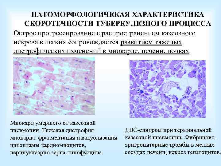 ПАТОМОРФОЛОГИЧЕКАЯ ХАРАКТЕРИСТИКА СКОРОТЕЧНОСТИ ТУБЕРКУЛЕЗНОГО ПРОЦЕССА Острое прогрессирование с распространением казеозного некроза в легких сопровождается
