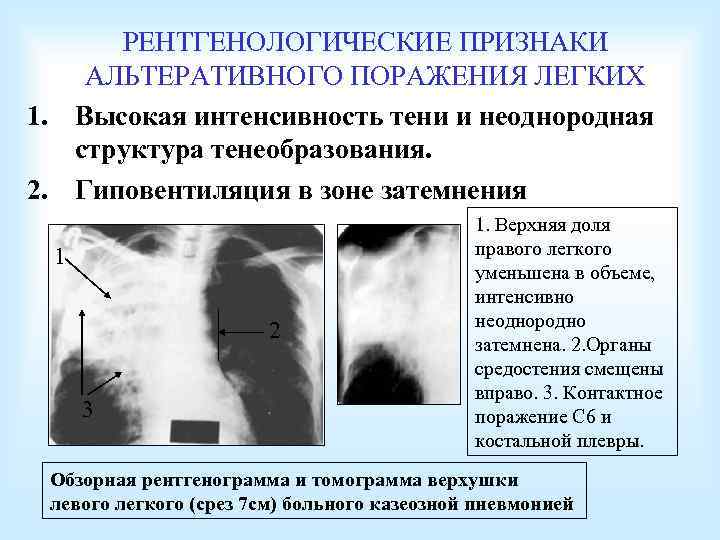 РЕНТГЕНОЛОГИЧЕСКИЕ ПРИЗНАКИ АЛЬТЕРАТИВНОГО ПОРАЖЕНИЯ ЛЕГКИХ 1. Высокая интенсивность тени и неоднородная структура тенеобразования. 2.