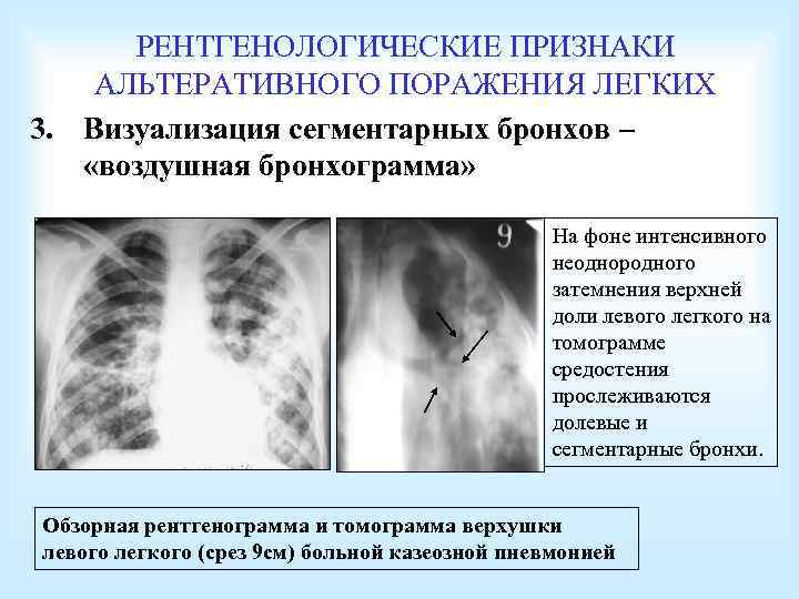 РЕНТГЕНОЛОГИЧЕСКИЕ ПРИЗНАКИ АЛЬТЕРАТИВНОГО ПОРАЖЕНИЯ ЛЕГКИХ 3. Визуализация сегментарных бронхов – «воздушная бронхограмма» На фоне