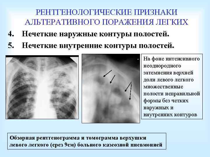 РЕНТГЕНОЛОГИЧЕСКИЕ ПРИЗНАКИ АЛЬТЕРАТИВНОГО ПОРАЖЕНИЯ ЛЕГКИХ 4. Нечеткие наружные контуры полостей. 5. Нечеткие внутренние контуры