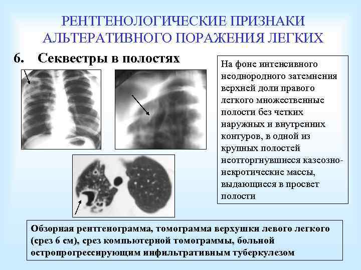 РЕНТГЕНОЛОГИЧЕСКИЕ ПРИЗНАКИ АЛЬТЕРАТИВНОГО ПОРАЖЕНИЯ ЛЕГКИХ 6. Секвестры в полостях На фоне интенсивного неоднородного затемнения