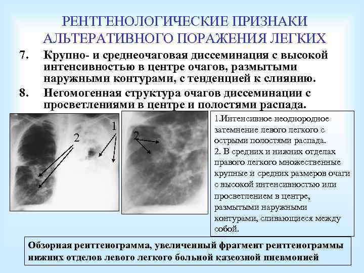 РЕНТГЕНОЛОГИЧЕСКИЕ ПРИЗНАКИ АЛЬТЕРАТИВНОГО ПОРАЖЕНИЯ ЛЕГКИХ 7. 8. Крупно- и среднеочаговая диссеминация с высокой интенсивностью