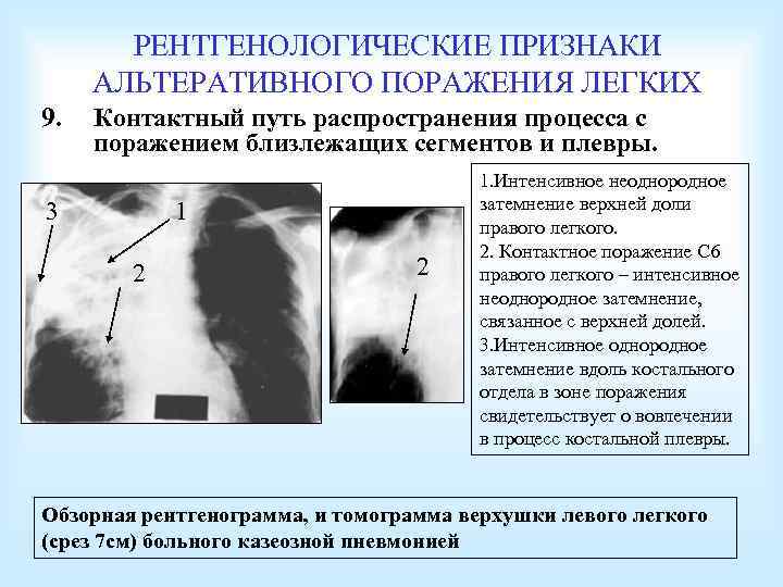 РЕНТГЕНОЛОГИЧЕСКИЕ ПРИЗНАКИ АЛЬТЕРАТИВНОГО ПОРАЖЕНИЯ ЛЕГКИХ 9. Контактный путь распространения процесса с поражением близлежащих сегментов